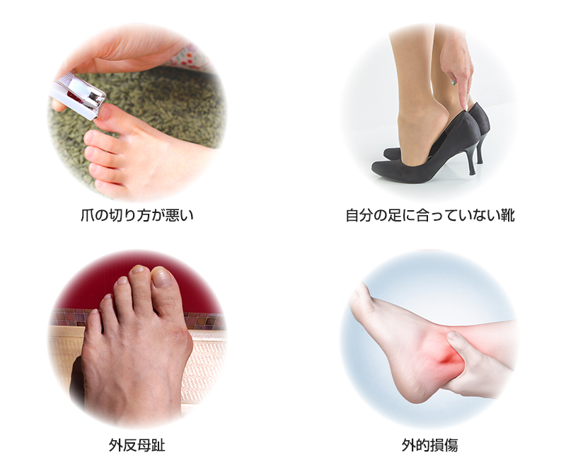 巻き爪の主な原因